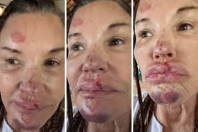 Supermodel Janice Dickinson is suing ITV claiming a fall during her appearance in I’m A Celebrity... has caused ‘facial scarring and deformity’