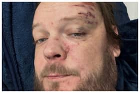 Pawn Stars’ Corey Harrison breaks rib cage in 11 places after motorcycle crash. Photo: realcoreyharrison/Instagram
