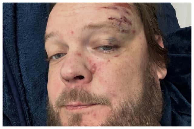 Pawn Stars’ Corey Harrison breaks rib cage in 11 places after motorcycle crash. Photo: realcoreyharrison/Instagram