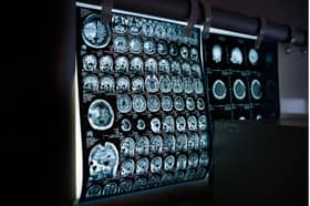 There is “no evidence that ADHD is overdiagnosed in the UK”, a team of experts has said