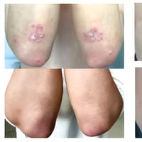 Psoriasis breakthrough as common vitamin B5 supplement shows promise in new study