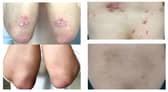A widely available nutritional supplement could help ease the symptoms of psoriasis according to promising new research.