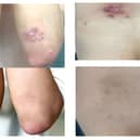 A widely available nutritional supplement could help ease the symptoms of psoriasis according to promising new research.