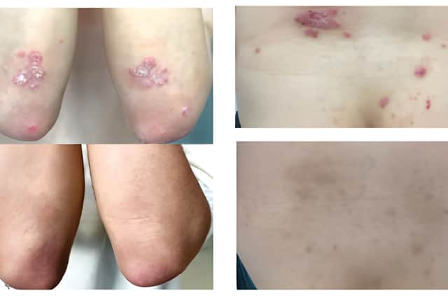 A widely available nutritional supplement could help ease the symptoms of psoriasis according to promising new research.