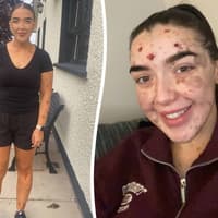 Mum with birthmarks covering 98% of her body reveals why she still won't leave home without makeup