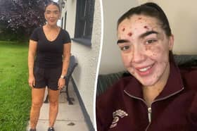  Laura Kelly, 28, was born with a rare skin condition called congenital melanocytic nevus 