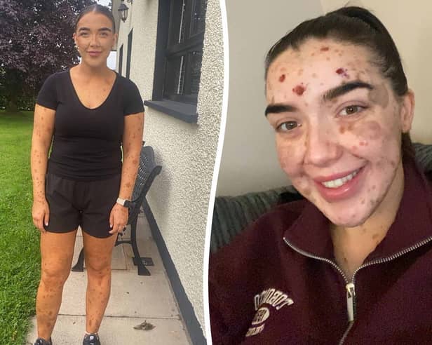  Laura Kelly, 28, was born with a rare skin condition called congenital melanocytic nevus 