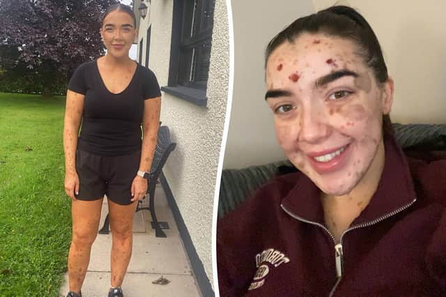 Laura Kelly, 28, was born with a rare skin condition called congenital melanocytic nevus