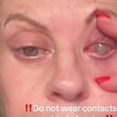 A mum was forced to have her eye sewn shut after parasites 'ate' through her cornea.