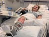 Teenager spent 17 months in Leeds hospital after tractor crash left her with ‘bomb-blast’ injuries