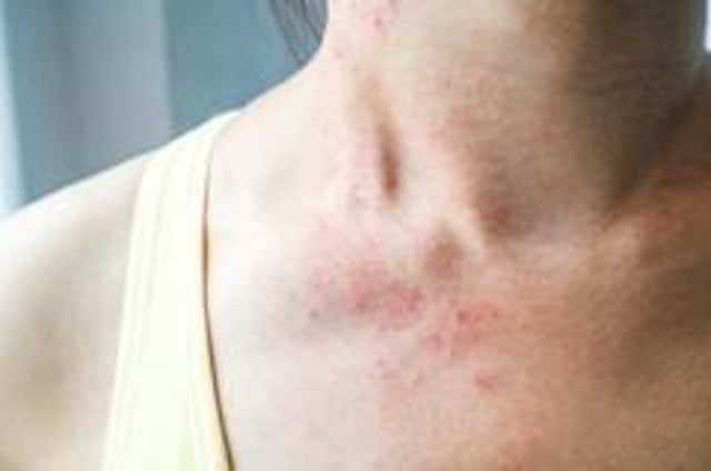 Eczema is more than just dry skin.