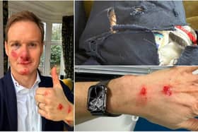 Dan Walker shared these photos of himself recovering at home following a car crash on Monday, where he says his bike helmet "saved his life".