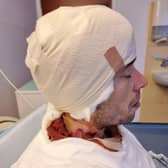PAUL ATKINS, 37, BANDAGED UP IN HOSPITAL AFTER THE ACID ATTACK