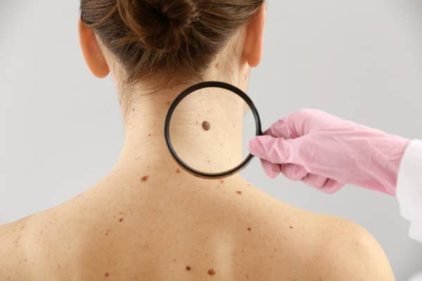 Spotting skin cancer early can greatly improve the prognosis (Photo: Shutterstock)