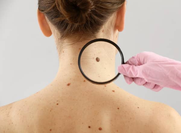 Spotting skin cancer early can greatly improve the prognosis (Photo: Shutterstock)
