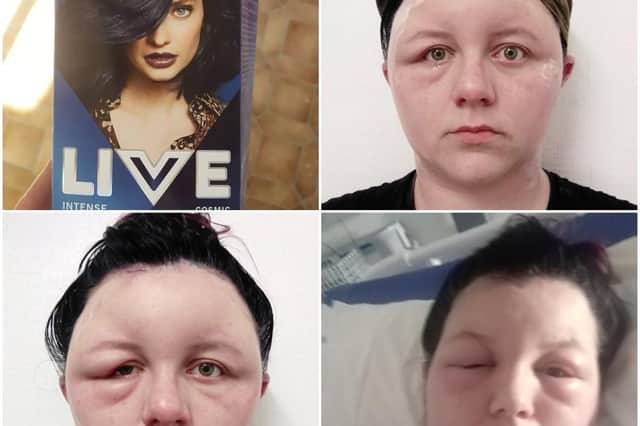 Allergic reaction to hair dye leaves woman hospitalised with scalp covered  in blisters and eyes swollen shut | NationalWorld