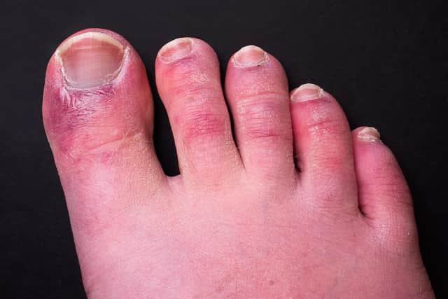 ‘Covid Toes’ can cause lesions on the toes of some people who have had coronavirus (Photo: Shutterstock)