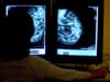 NHS: 300,000 women to be offered new breast cancer drug - how it works