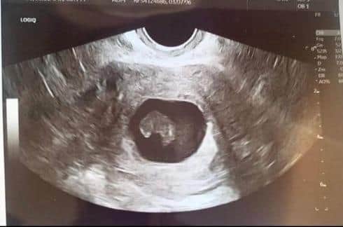 A scan of the baby which later sadly miscarried 