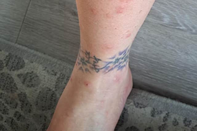 A single mum claims she was bitten '100 times' on her five-star TUI holiday - as her room was so infested with mosquitos she 'needed a hazmat suit'.