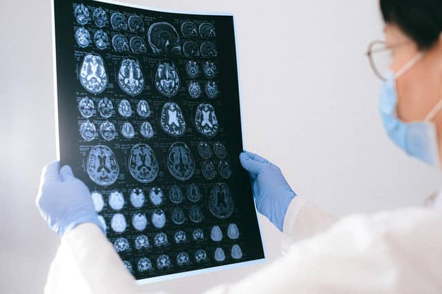Unlike existing therapies that attempt to slow progression once memory and cognition are already affected, Duvax is being developed as a secondary prevention therapy.