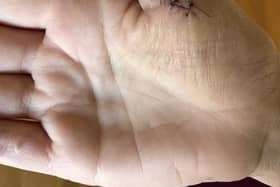 The 40-year-old was opening a tin of Ambrosia Rice Pudding with a can opener when she sliced the base of her thumb against the sharp ridge of the dessert container.
