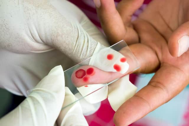 The World Health Organisation (WHO) has said cutting the UK’s foreign aid spending will leave millions of people at risk of dying from “neglected tropical diseases” (Photo: Shutterstock)