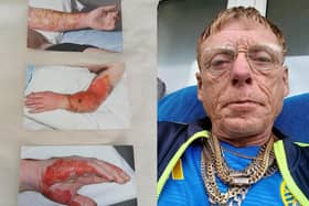 Stephen, from Leeds, needs 24-hour care, and suffers from memory loss (Cover Images)