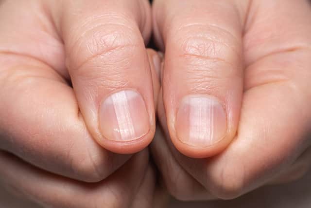 'Beau's lines' are transverse indents in the nail (Photo: Shutterstock)