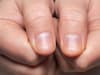 Covid nails: key signs of new symptom of coronavirus infection - and what causes it?