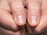 'Beau's lines' are transverse indents in the nail (Photo: Shutterstock)
