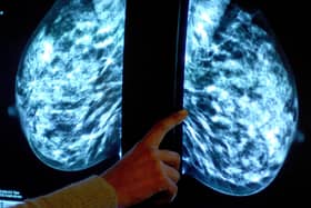 A mammogram scan looking for breast cancer Picture: PA
