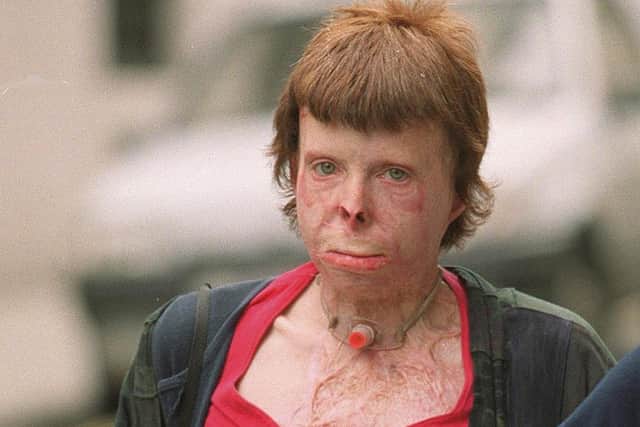 Steven Craig, 58, inflicted horrendous injuries to Jacqueline Kirk in a car park in Weston-super-Mare, Somerset, in April 1998.