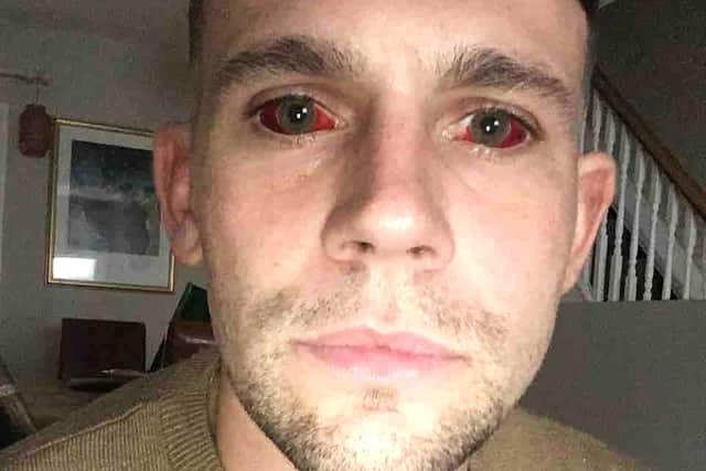Dave Mullen, now 34, in august 2021, after a five-day cocaine bender which left him in a coma and all the blood vessels in his eyes popped