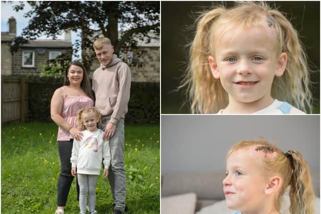 Emily Hill was struck by the "near silent" bike and now faces cosmetic surgery (SWNS)