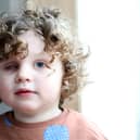 Teddy Waddle lost his eye after being diagnosed with retinoblastoma – a type of eye cancer.