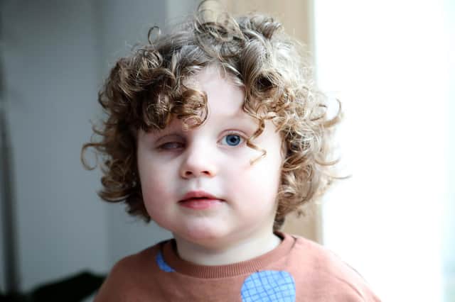 Teddy Waddle lost his eye after being diagnosed with retinoblastoma – a type of eye cancer.