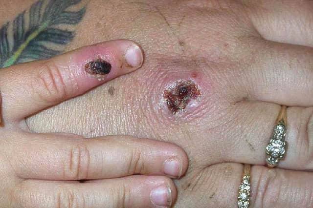Monkeypox is a rare disease caused by infection with the monkeypox virus (Photo: CDC/Getty Images)